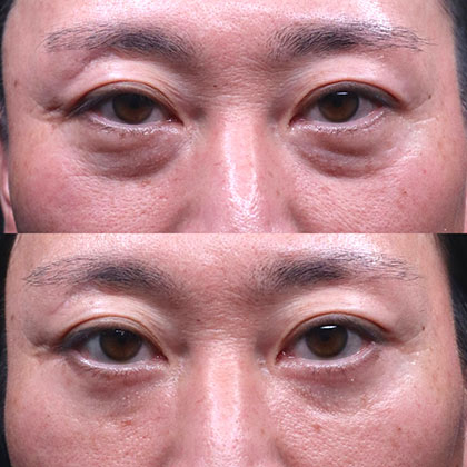経皮的眼窩脂肪移動術(表ハムラ法)