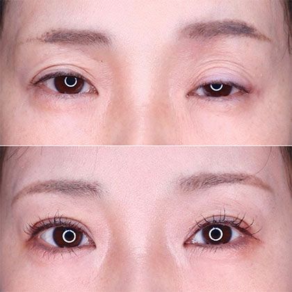 眼瞼下垂術
