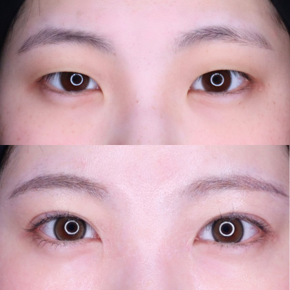 埋没二重術、目頭切開術