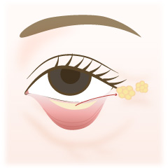 下まぶた脱脂の手術内容01