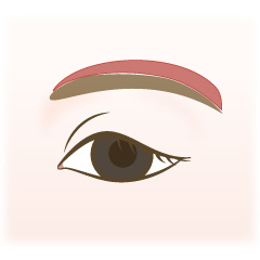 眉毛リフト(軽度の場合)の手術内容01