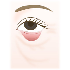 経結膜的眼窩脂肪移動術(裏ハムラ法)の手術内容01