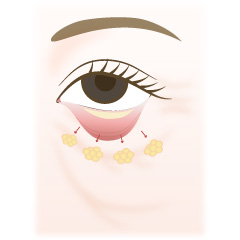 経結膜的眼窩脂肪移動術(裏ハムラ法)の手術内容02