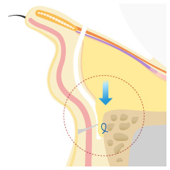 経結膜的眼窩脂肪移動術(裏ハムラ法)の手術内容04