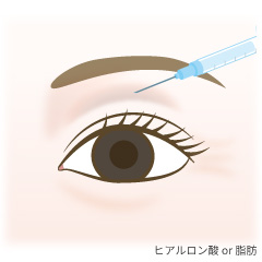 くぼみ目形成の手術内容01