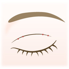 埋没法の手術内容01