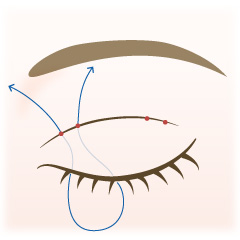 埋没法の手術内容02