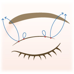 埋没法の手術内容03