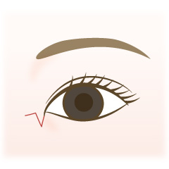 目頭切開の手術内容01