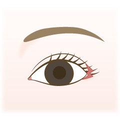 目尻切開の手術内容01