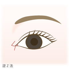 蒙古ひだ形成(目頭切開修正術)の手術内容01
