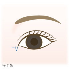 蒙古ひだ形成(目頭切開修正術)の手術内容02
