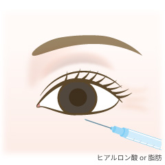 涙ぶくろ形成の手術内容01