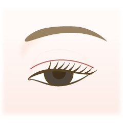 後天性眼瞼下垂の手術内容01