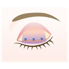 後天性眼瞼下垂の手術内容02