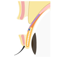 後天性眼瞼下垂の手術内容03