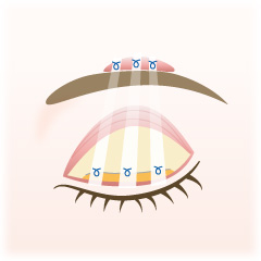 先天性眼瞼下垂の手術内容02