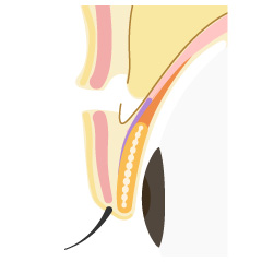 切開法の手術内容02