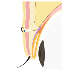切開法の手術内容03