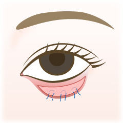 たれ目形成の手術内容02