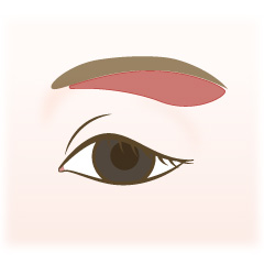 眉毛下皮膚切除術(上眼瞼リフト)の手術内容01