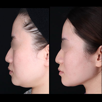 頬顎下脂肪吸引、糸リフト