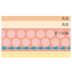 糸リフトの手術内容02