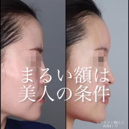 額ヒアルロン酸注入
