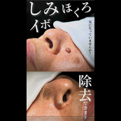 炭酸ガスレーザー