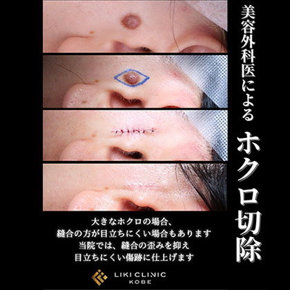 ほくろ切除