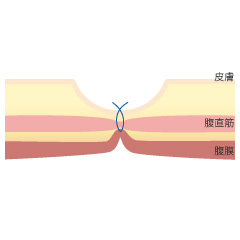 臍ヘルニアの手術の内容03
