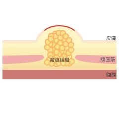 臍形成の手術の内容02
