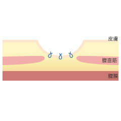 臍形成の手術の内容03