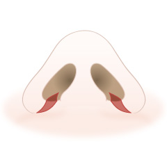 鼻翼縮小術(内側)の手術内容01