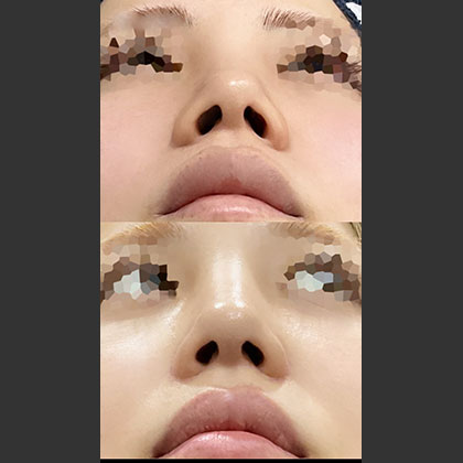鼻翼縮小