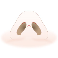 斜鼻修正の手術内容01